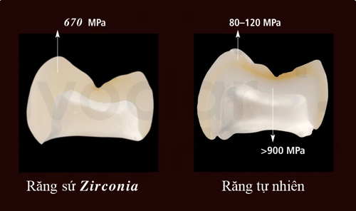 bọc răng sứ zirconia