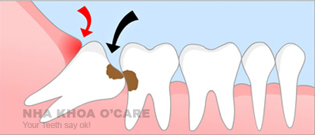 Nhổ răng hàm số 8 (răng khôn)