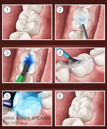 Trám răng, biện pháp phòng ngừa răng sâu cho trẻ em