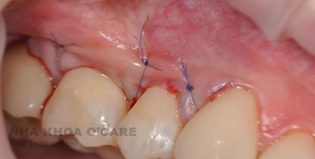 Phẫu thuật điều trị tụt nướu