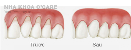 Phẫu thuật điều trị tụt nướu