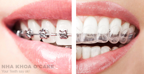 niềng răng trong suốt invisalign